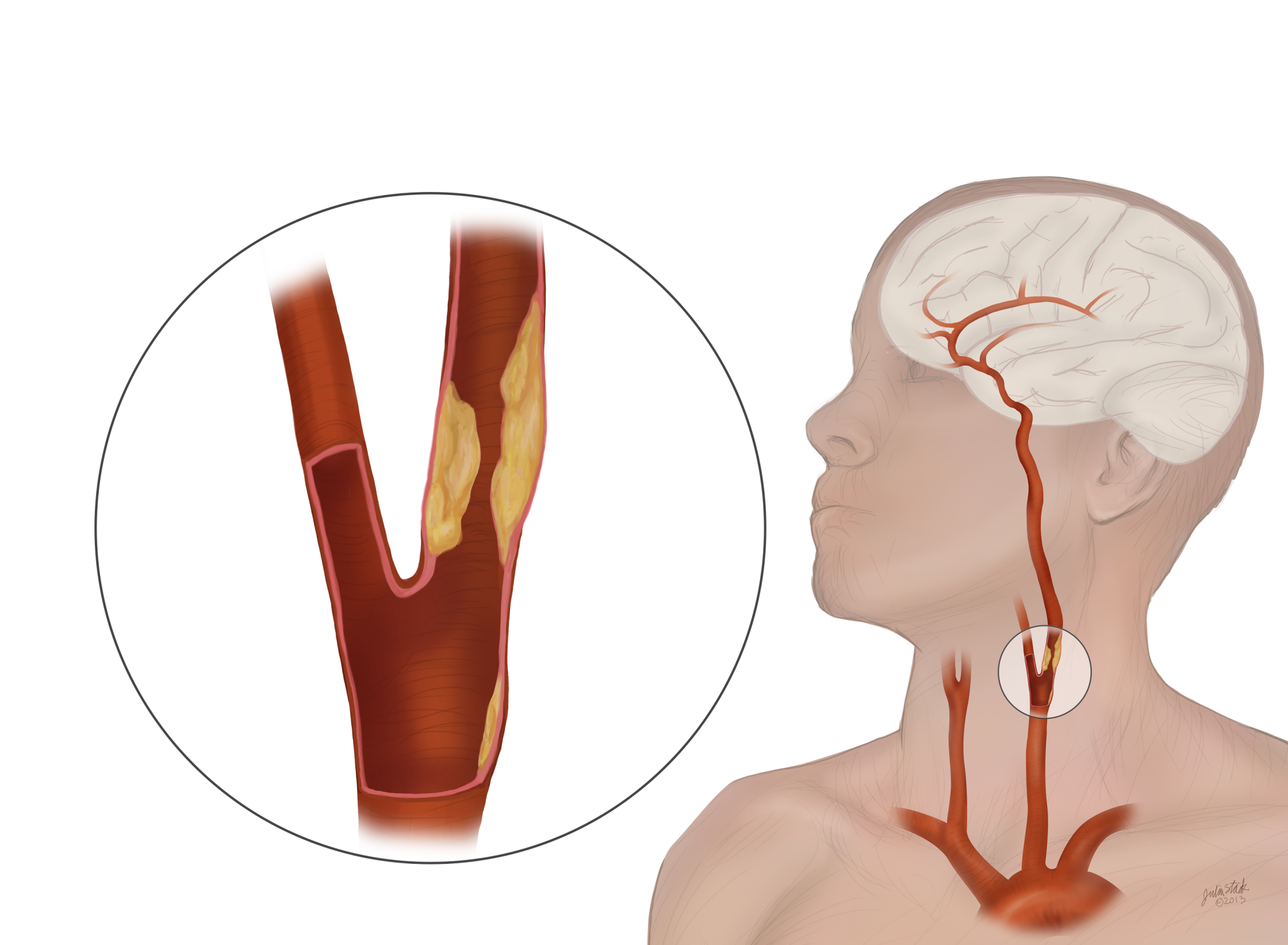 Carotid Artery Stenosis: Causes, Symptoms And Treatment