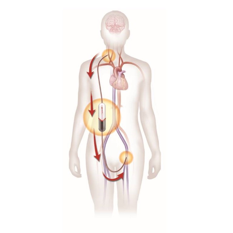 carotid-artery-disease-treatment-how-tcar-works