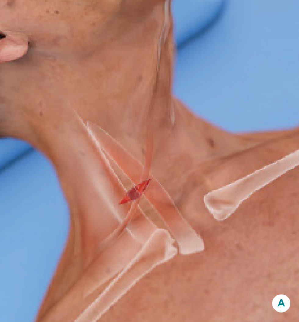 Carotid Artery Disease Treatment How TCAR Works