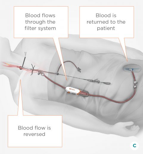 Carotid Artery Disease Treatment How Tcar Works 6215