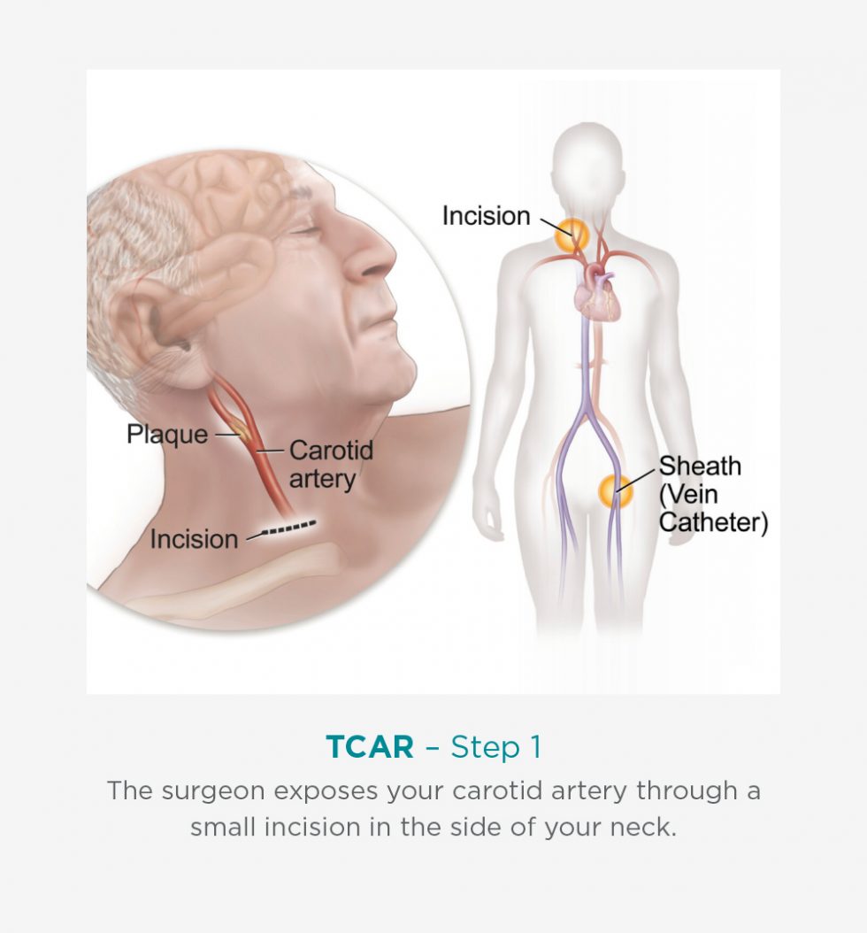 Carotid Intervention TCAR Procedure Benefits & Recovery